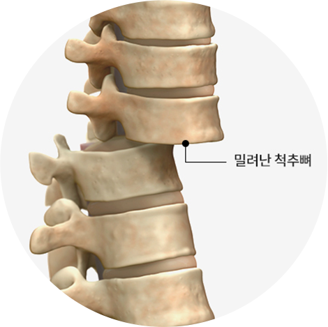 척추전방전위증 표현한 일러스트