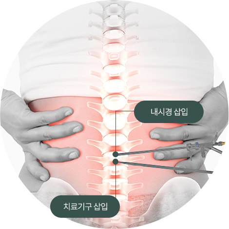 양방향 척추내시경 표현한 일러스트