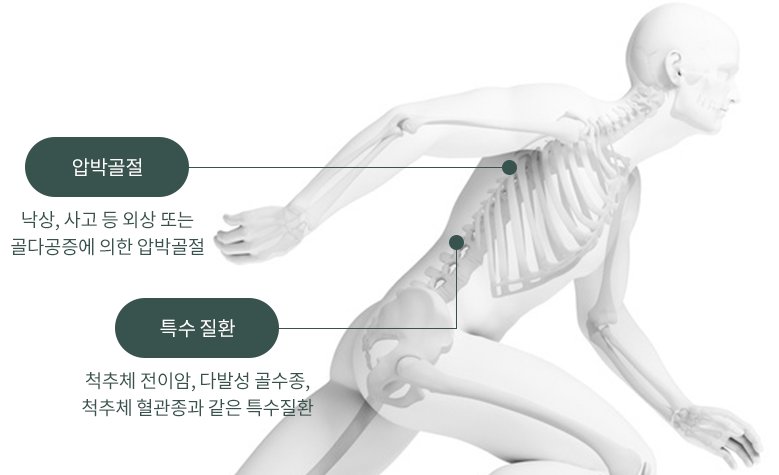 압박골절 : 낙상, 사고 등 외상 또는 골다공증에 의한 압박골절 / 특수 질환 :  척추체 전이암, 다발성 골수종, 척추체혈관정과 같은 특수질환