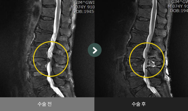 양방향 척추내시경(추간판 제거, 후궁감압술) 수술 전 > 수술 후 비교