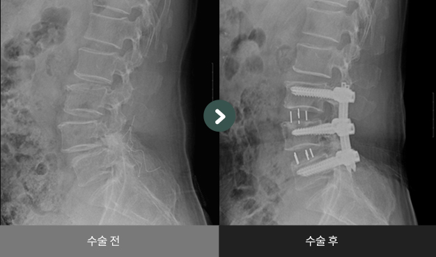 사측방 척추유합술(OLIF) 수술 전 > 수술 후 비교
