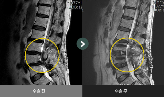 사측방 척추유합술(OLIF) 수술 전 > 수술 후 비교2