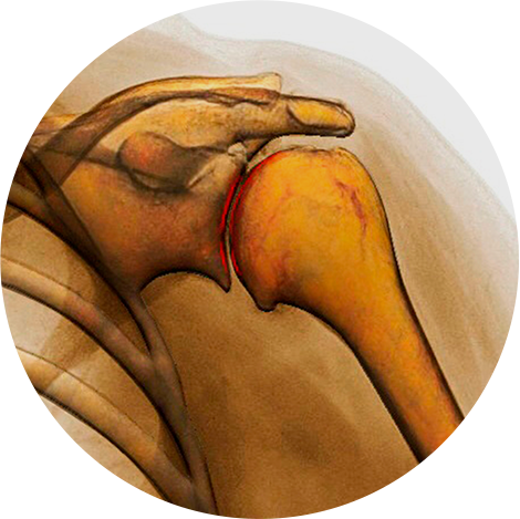 어깨 관절와순봉합술 표현한 일러스트