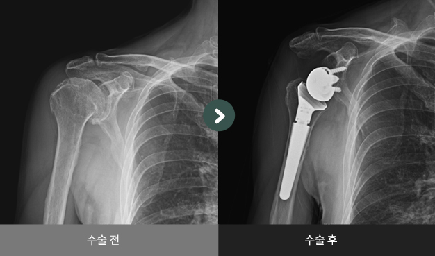 어깨 인공관절 반치환술 수술 전 > 수술 후 비교2