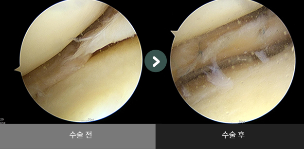 무릎 연골판 봉합술 수술 전 > 수술 후 비교