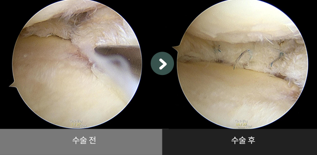 무릎 연골판 봉합술 수술 전 > 수술 후 비교2