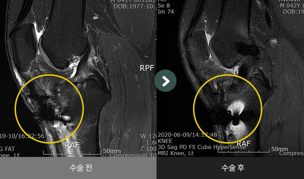 전방 십자인대 재건술 수술 전 > 수술 후 비교