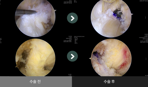 전방 십자인대 재건술 수술 전 > 수술 후 비교2