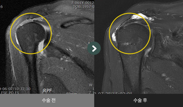 어깨 회전근개 봉합술 수술 전 > 수술 후 비교