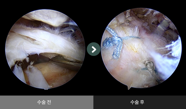 어깨 회전근개 봉합술 수술 전 > 수술 후 비교2