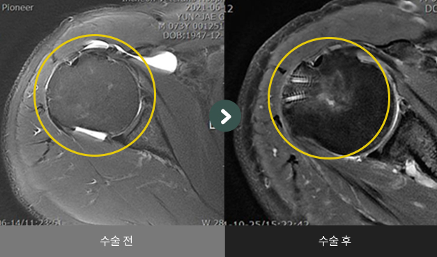 관절와순봉합술 및 극상건 봉합술 수술 전 > 수술 후 비교