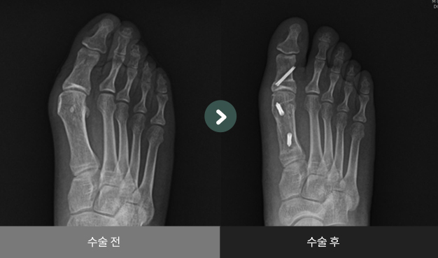 무지외반증 수술 전 > 수술 후 비교2