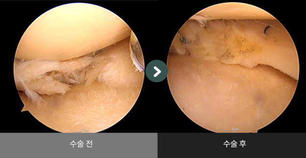 무릎 관절내시경 수술 수술사례 수술 전 > 수술 후 비교