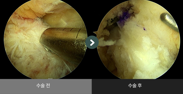 무릎 관절내시경 수술 수술사례 수술 전 > 수술 후 비교2