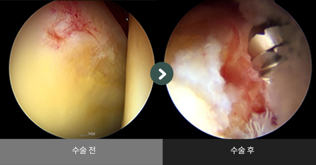고관절 충돌증후군 관절내시경 수술사례 수술 전 > 수술 후 비교