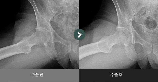고관절 충돌증후군 관절내시경 수술사례 수술 전 > 수술 후 비교2
