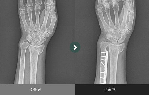 척골 단축술 수술 전 > 수술 후 비교2