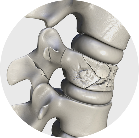 척추압박골절 표현한 일러스트