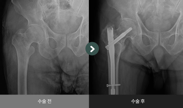우측 대퇴전자부 골절 수술 전 > 후