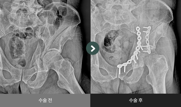 골반주 골절 수술 전 > 후