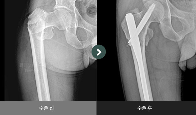 전자하 골절 수술 전 > 후
