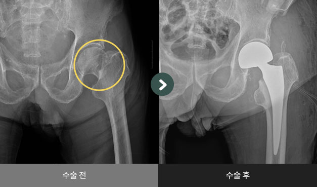 좌측 대퇴 경부 골절 수술 전 > 후