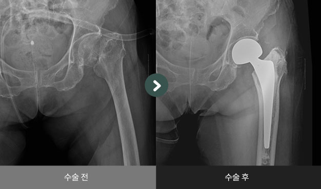 좌측 대퇴 경부 골절 수술 전 > 후