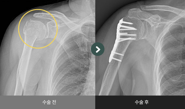 근위 상완골 골절 수술 전 > 후