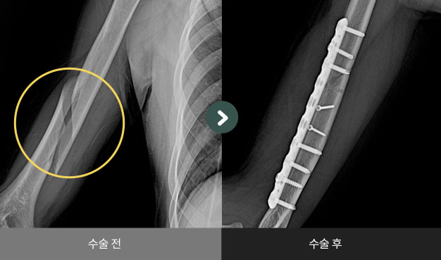 상완골 간부 골절 수술 전 > 후