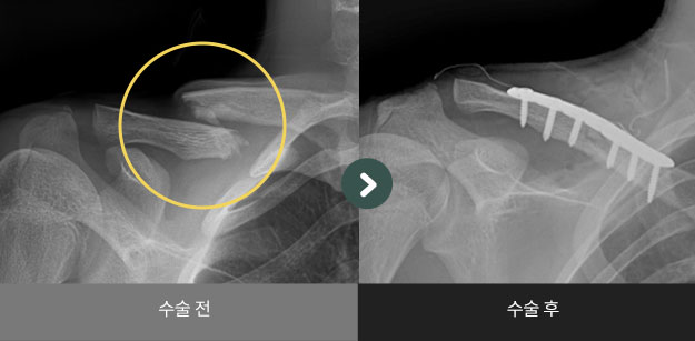 쇄골 골절 수술 전 > 후