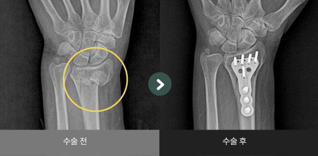 원위 요척골 골절 수술 전 > 후